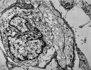 M,15y. | rhabdomyoma - lip M,15y. | rhabdomyoma - lip